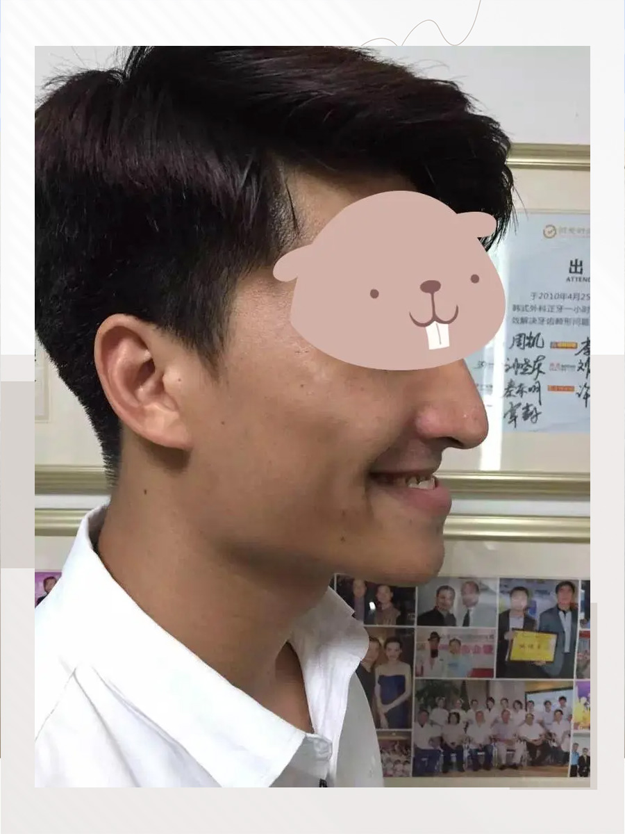 地包天矫正-地包天矫正图片