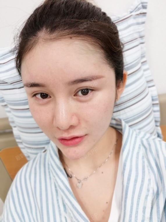 玻尿酸丰额头(玻尿酸丰额头多久能消肿自然)
