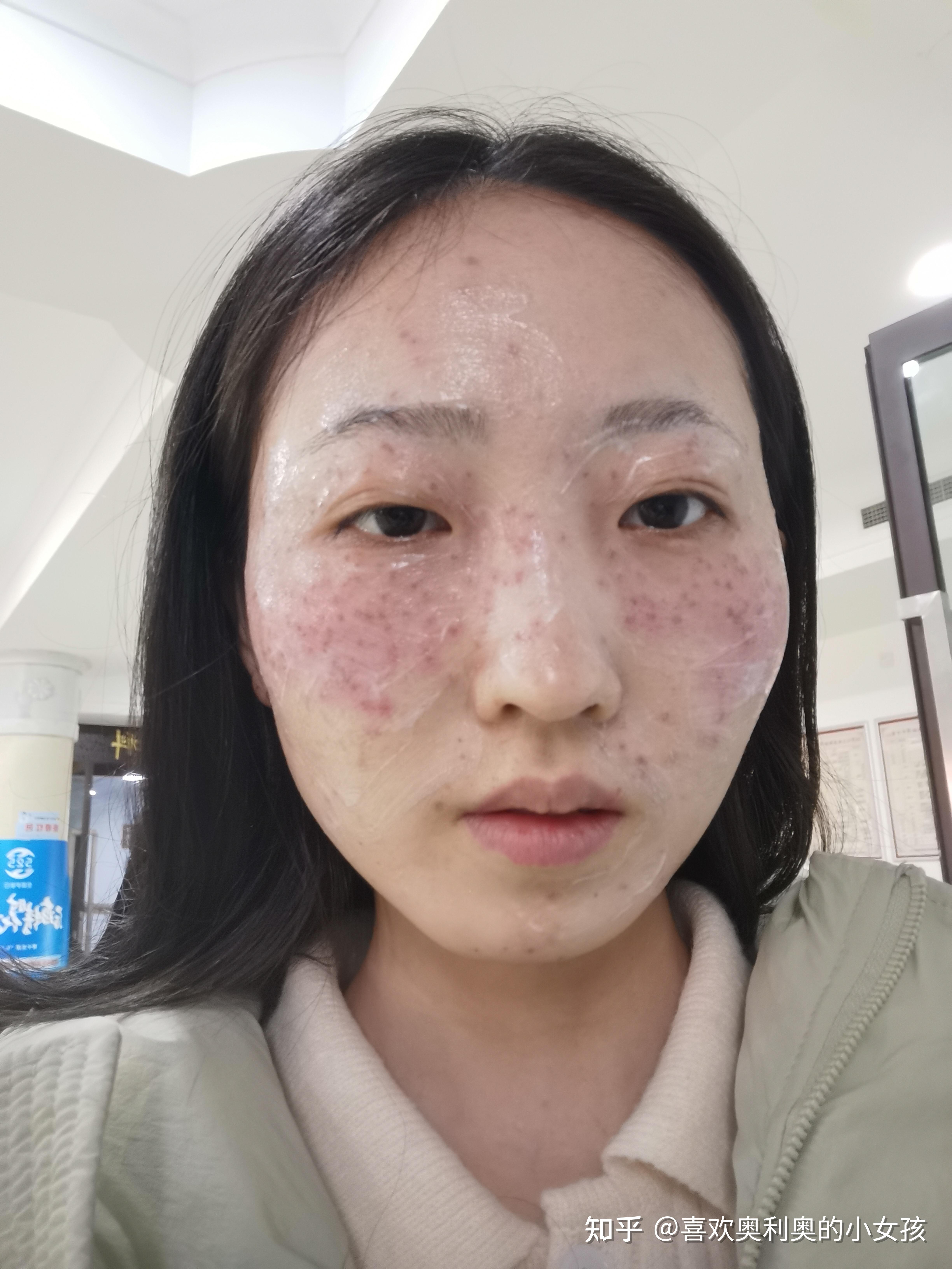 激光去斑(激光去斑点大概需要多少钱呢)
