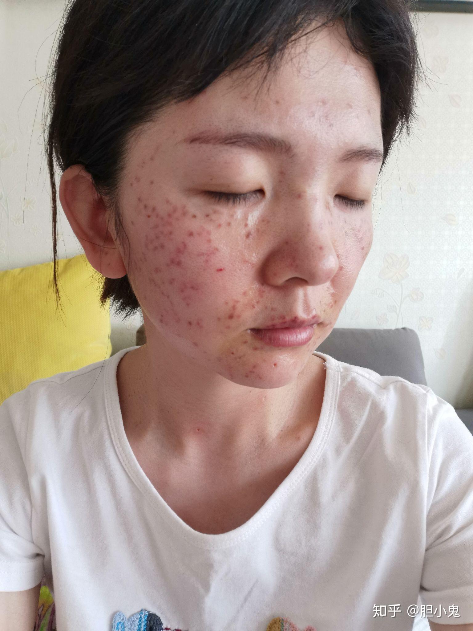 激光去斑(激光去斑点大概需要多少钱呢)