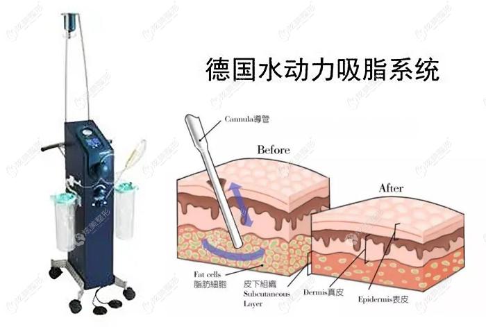 水动力吸脂-水动力吸脂和负压吸脂哪个好