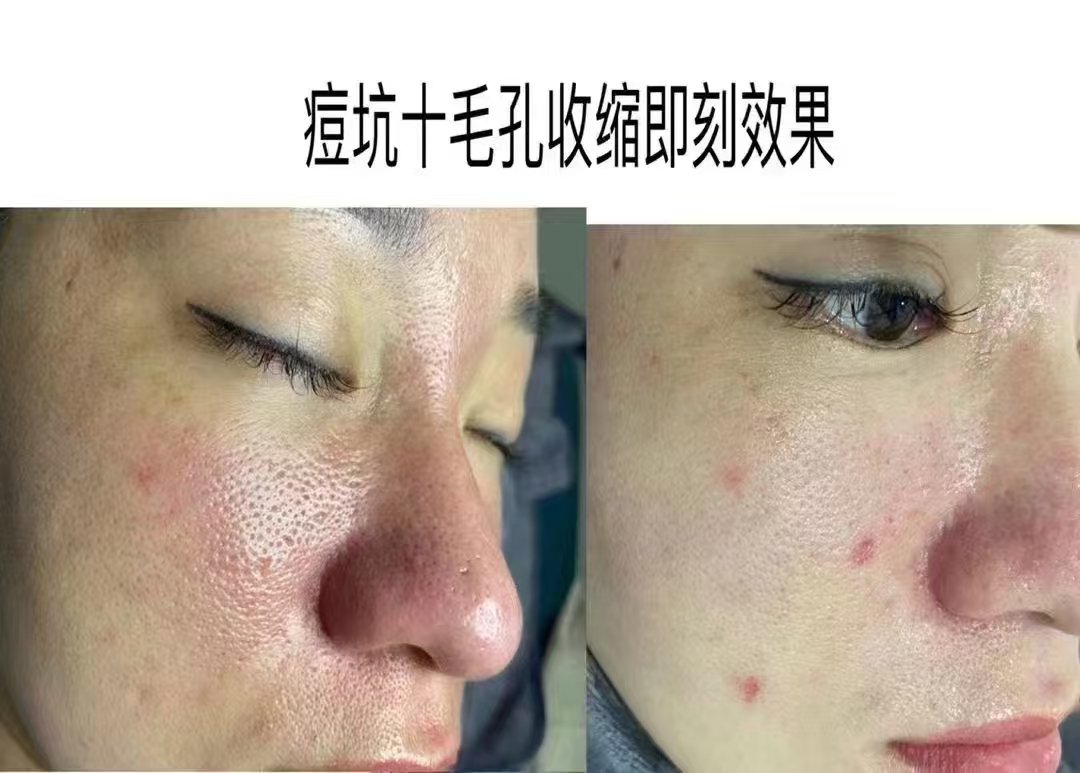 收缩毛孔_(收缩毛孔做什么医美项目比较好)