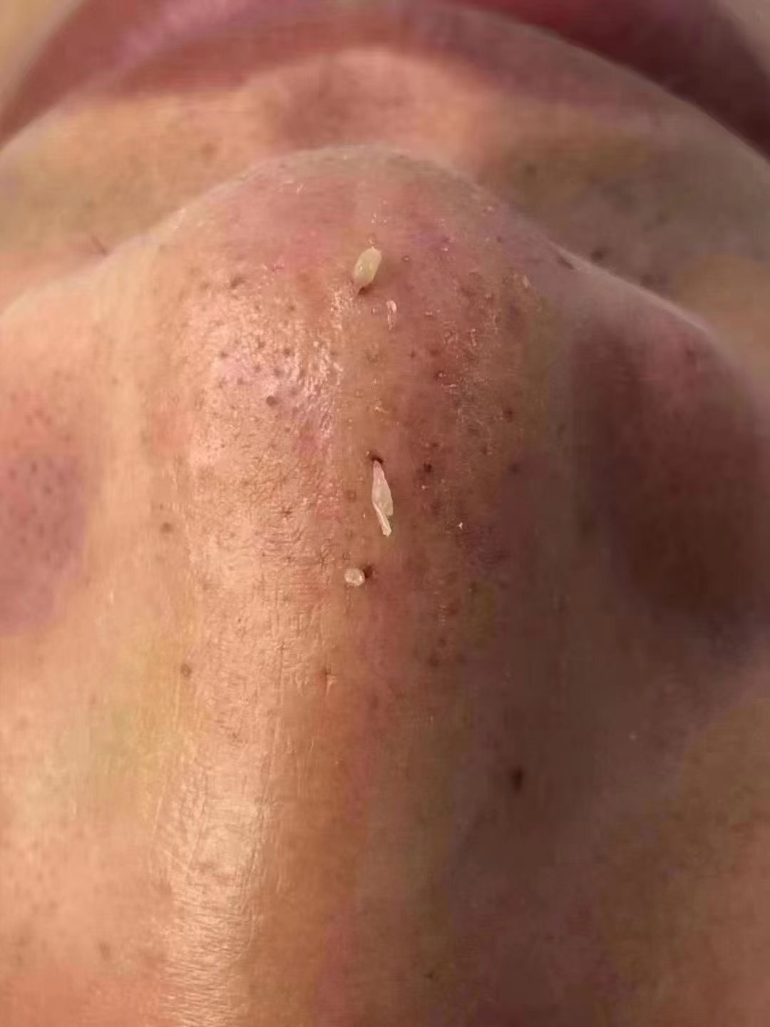收缩毛孔_(收缩毛孔做什么医美项目比较好)