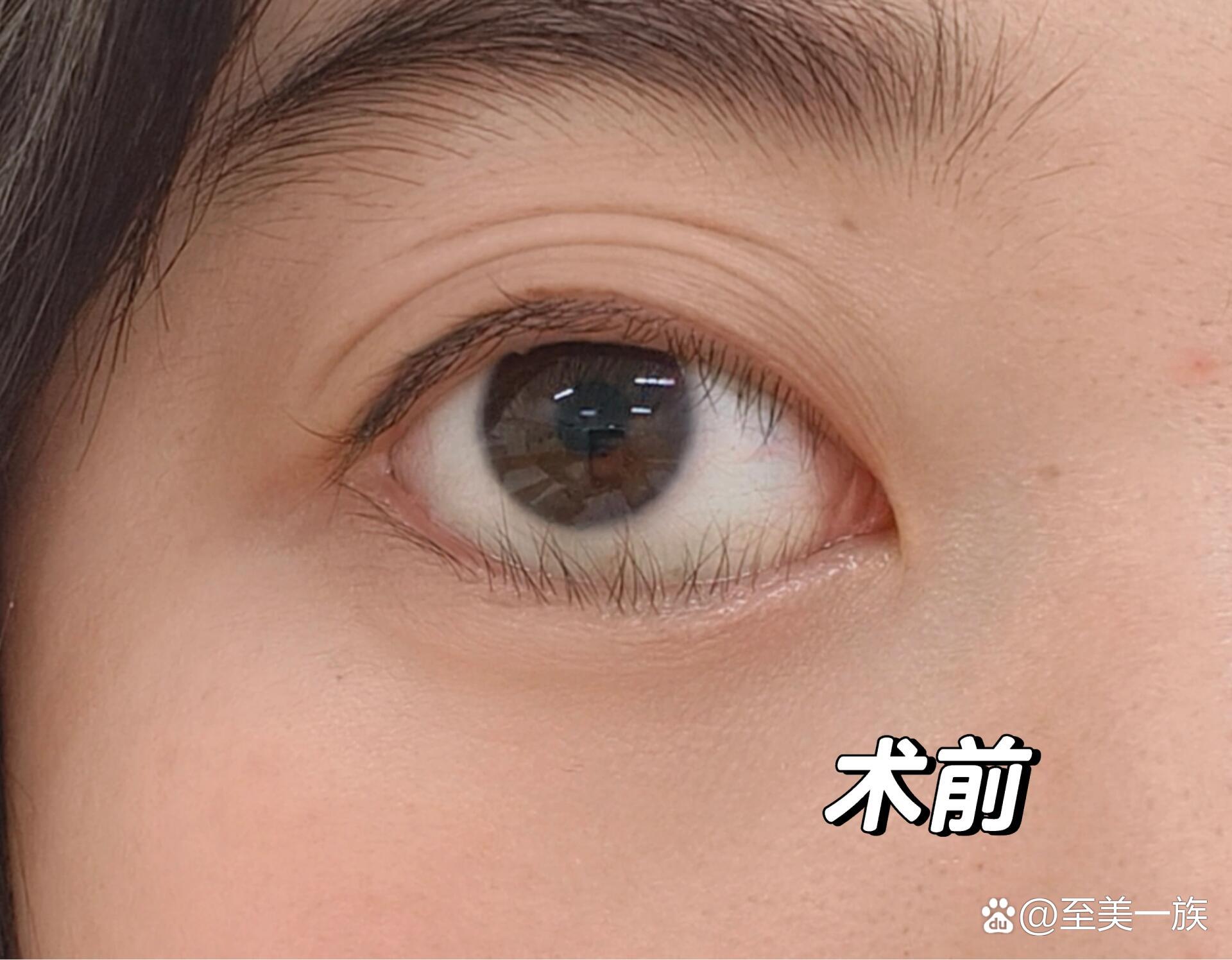 倒睫毛有什么症状-倒睫毛有什么坏处
