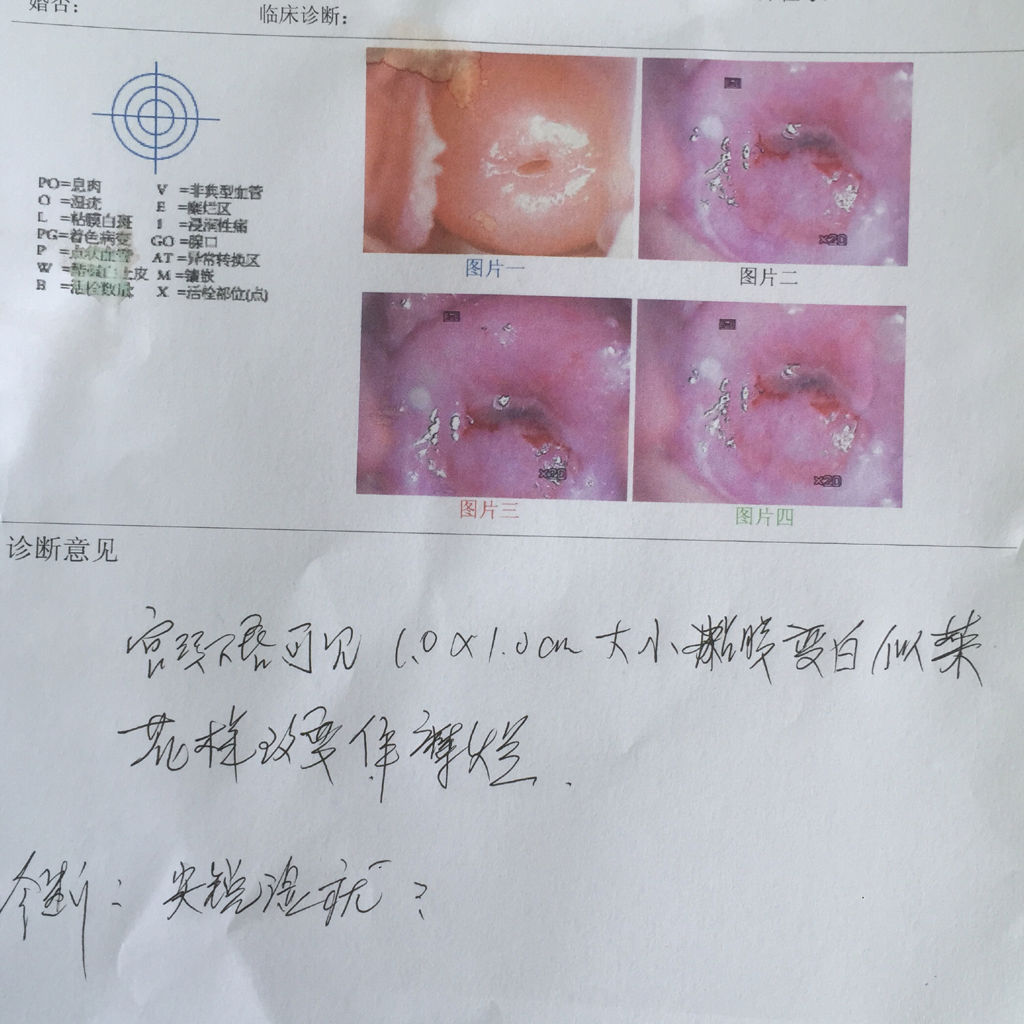宫颈湿疣_(宫颈疣体真实图片)