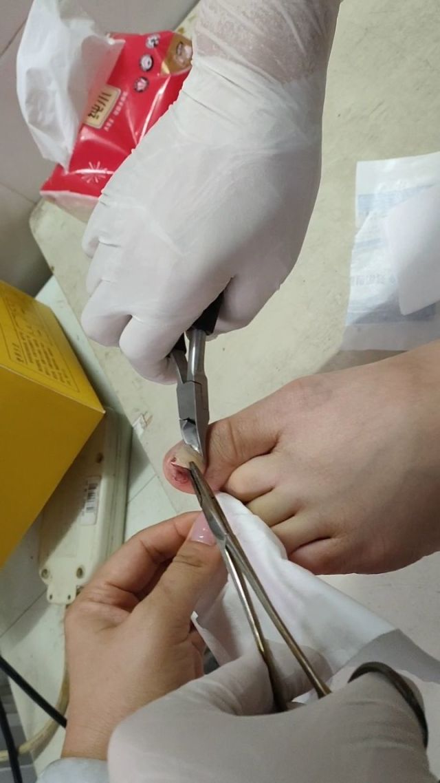 拔指甲(拔指甲属于几级疼痛)