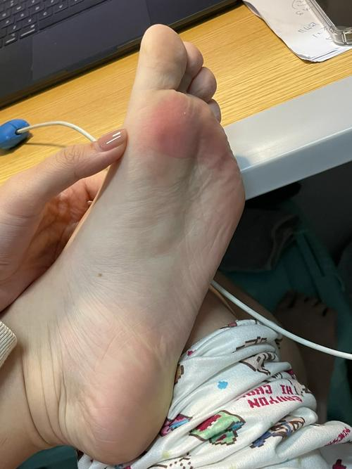 小脚趾外侧一按痛_(小脚趾外侧一按痛自己修)