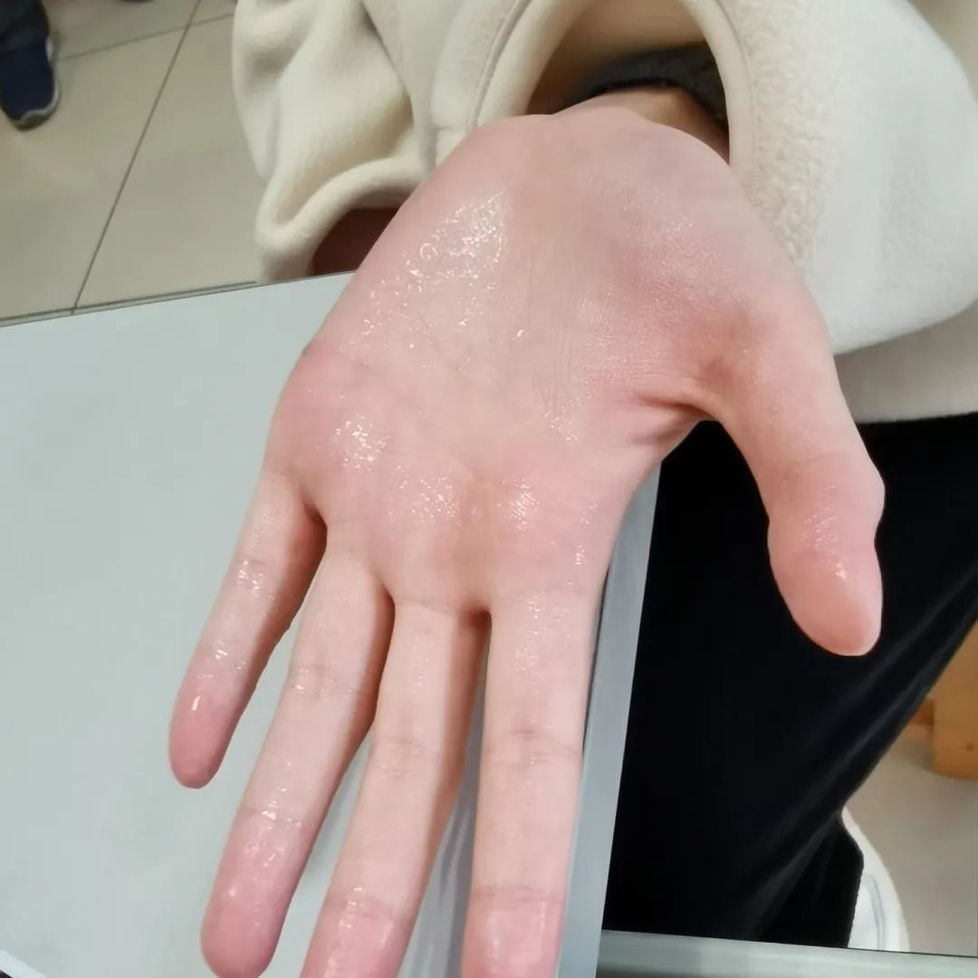 手汗症-手汗症手术我后悔了