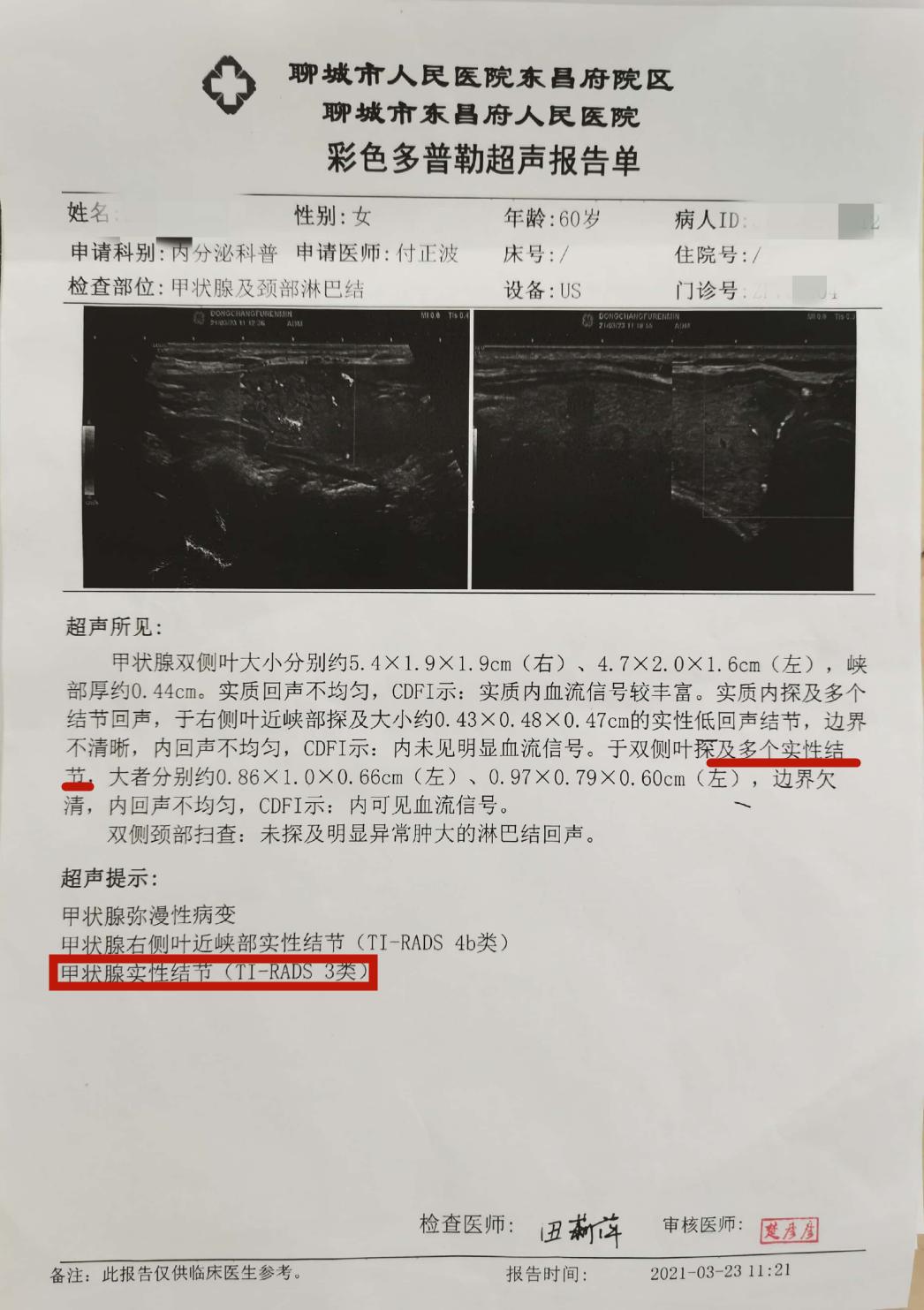 甲状腺双侧叶结节-甲状腺双侧叶结节cTIRADS3类是什么意思