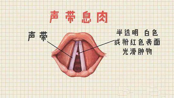 声带水肿-声带水肿咽喉炎声音长期嘶哑怎么办