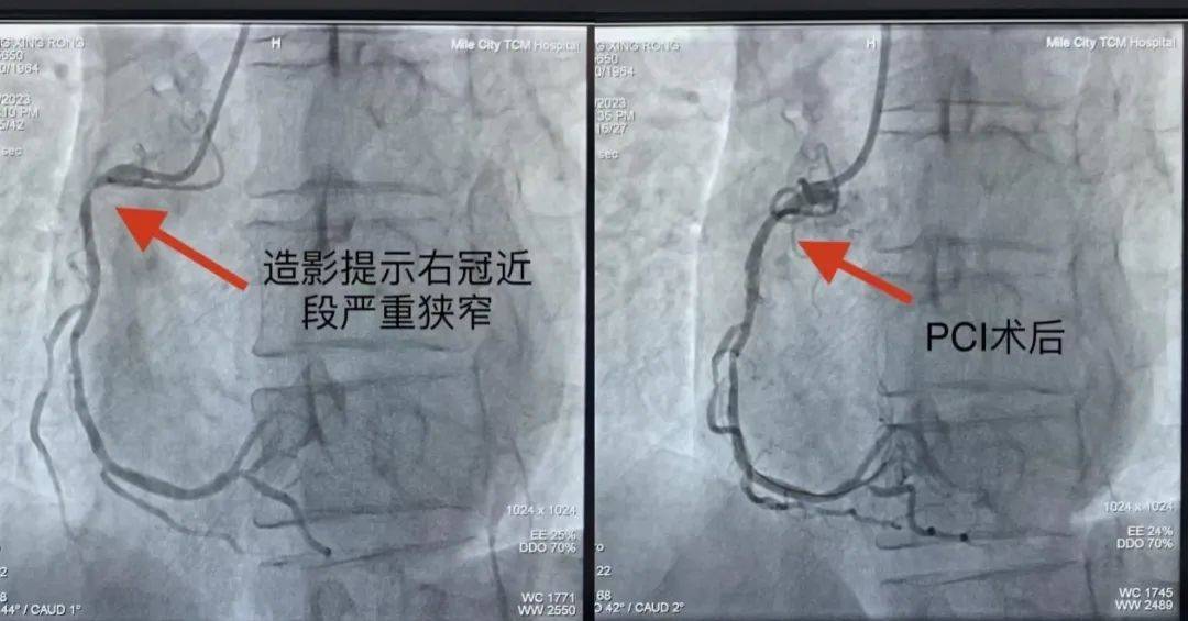 主动脉及冠脉钙化(主动脉及冠脉钙化需要治疗吗)
