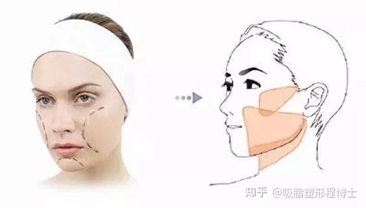 脸部吸脂(脸部吸脂会皮肤松弛吗)