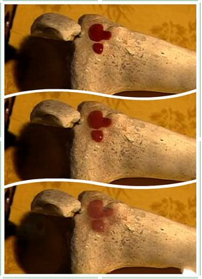 骨头钙化_(骨头钙化的症状)