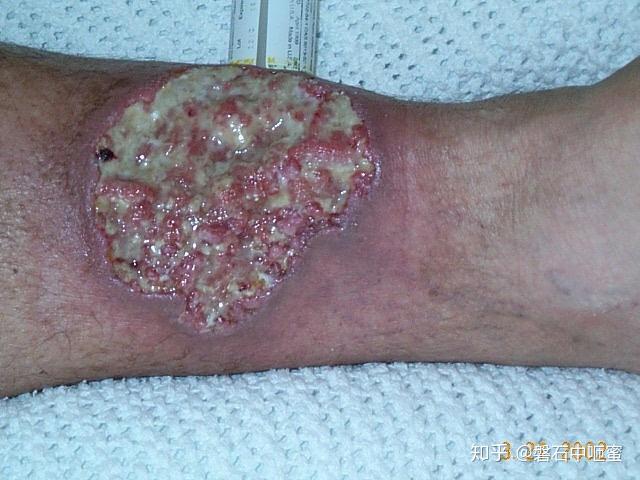 克罗恩病症状(肠胃克罗恩病症状)